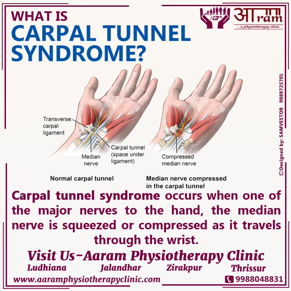 Carpal Tunnel Syndrome Cts Definition Symptoms Causes And Exercises