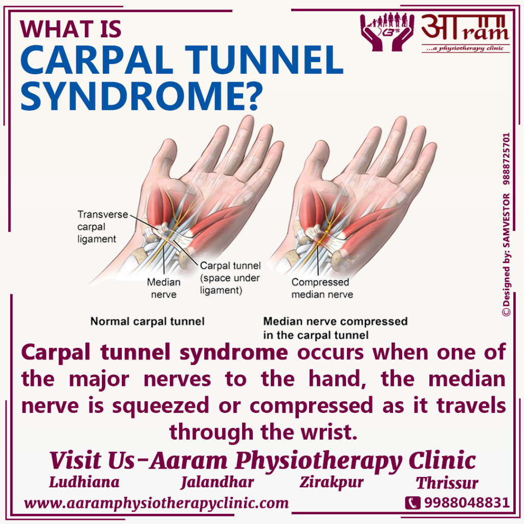 Carpal Tunnel Syndrome (CTS) Definition, Symptoms, Causes & Exercises