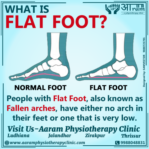 FLAT FOOT- Definition, Symptoms, Causes & Rehabilitation Exercises