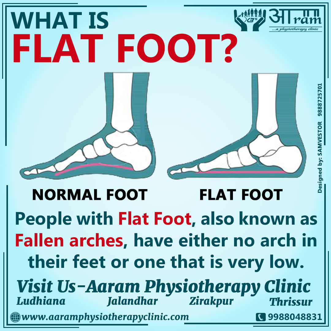 what does it mean to be flat footed